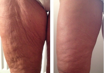 Nie wieder Cellulite mit unserer einzigartigen Creme